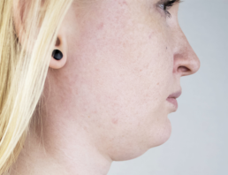 menton avant genioplastie