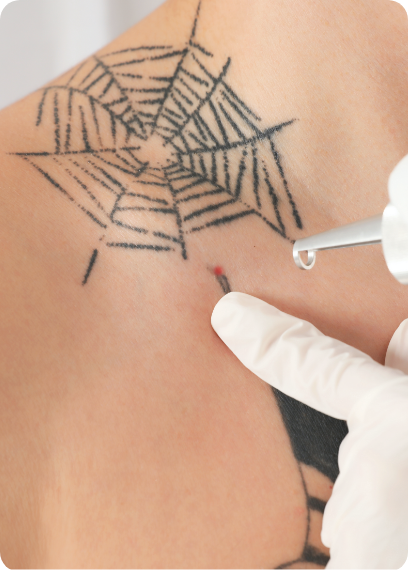 détatouage laser d'un tatouage sur épaule